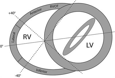 Right ventricular electromechanical dyssynchrony in adults with repaired Tetralogy of Fallot